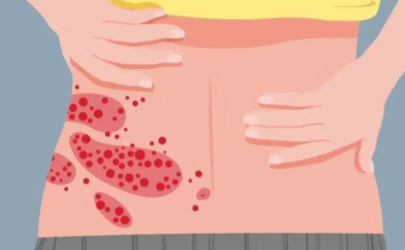 帶狀皰疹有時會被誤認是皮炎嗎