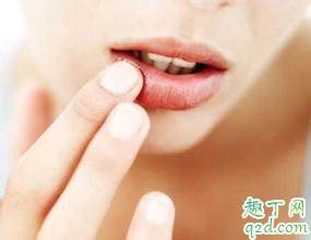 什么原因导致嘴唇干裂 嘴唇干裂有什么办法快速恢复