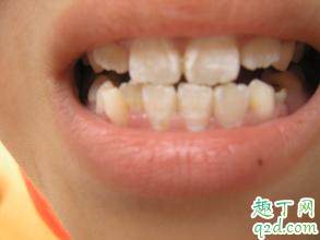 什么是氟斑牙 儿童为什么会得氟斑牙