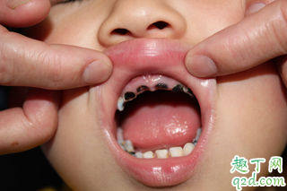 有蛀牙需要补吗 蛀牙痛怎么快速止痛