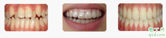 牙齿错位有什么危害 牙齿错位怎么矫正