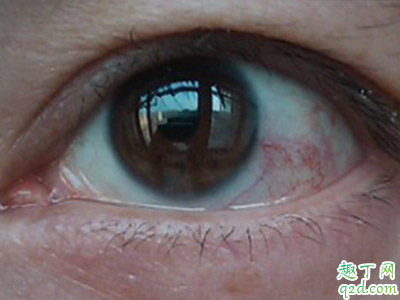 干眼症是什么引起的 如何预防干眼症
